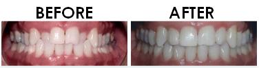 crossbite before and after