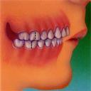 correct overbite