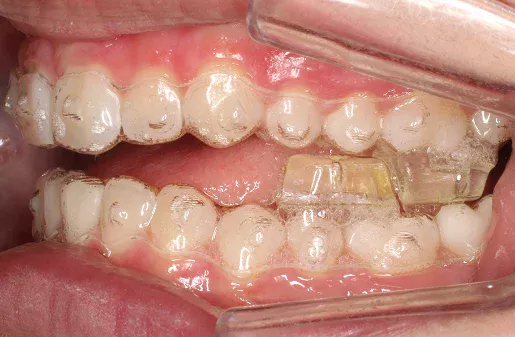 Invisalign with Occlusal Blocks